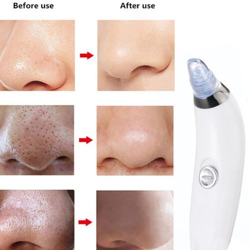 Вакуумный аппарат Derma Suction прибор для чистки пор и удаления черных точек, пилинг для лица, очиститель, аппарат-очиститель кожи 4 насадки Белый